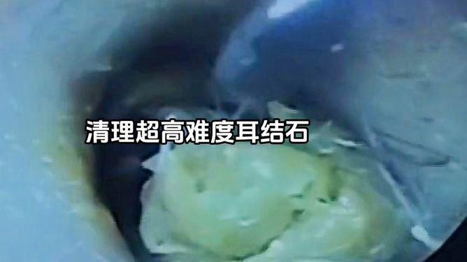 大便连绵不断：大便断断续续拉不干净 